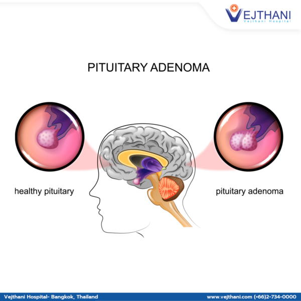 "Understanding Pituitary Adenomas: Overview Of Symptoms, Diagnosis, And ...