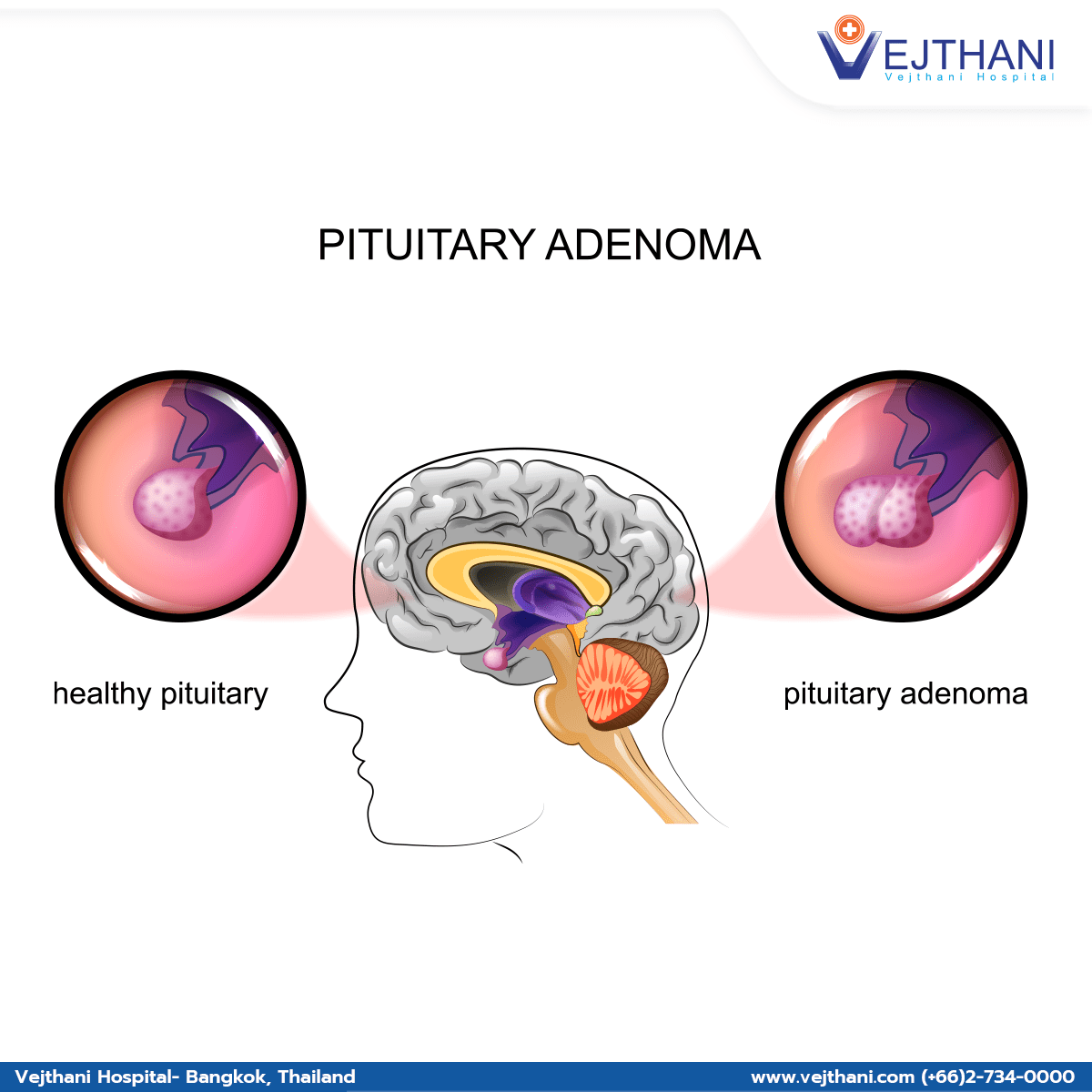 Understanding Pituitary Adenomas Overview Of Symptoms Diagnosis And Treatment Options 6914