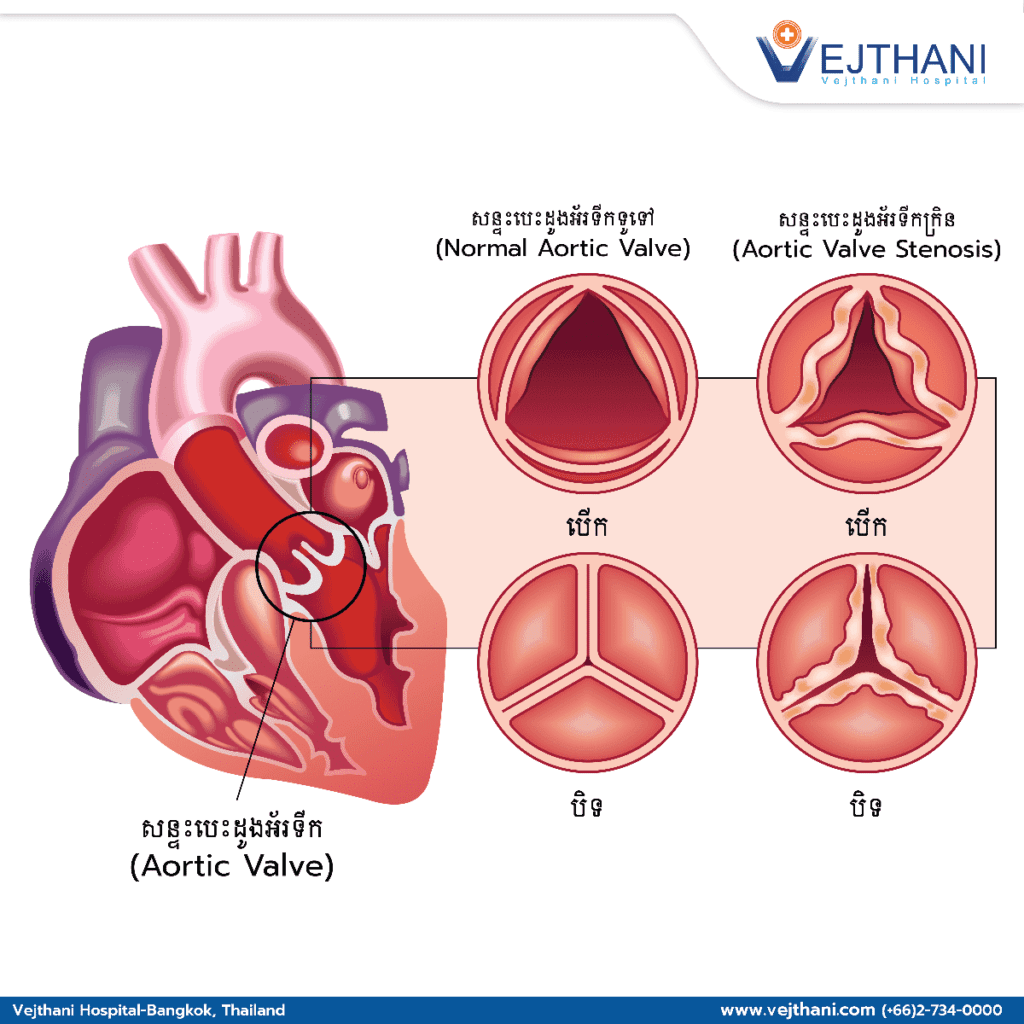 ជំងឺសន្ទះបេះដូងអ័រទីក Aortic Valve Disease Vejthani Hospital Jci