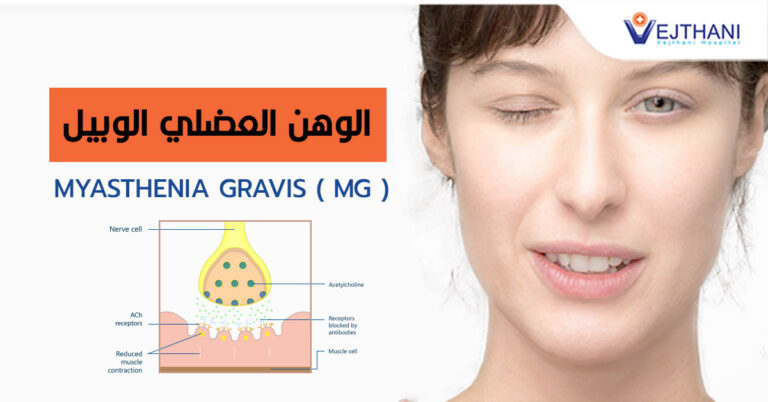 Myasthenia gravis_MG