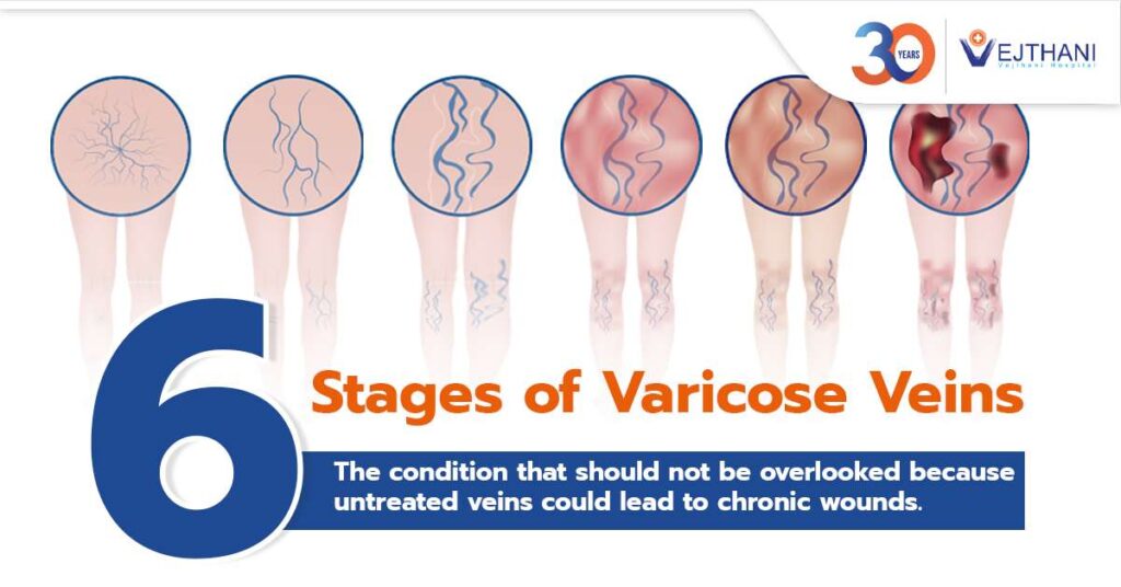 Trusted Specialists, Proven Results: Experience Advanced Varicose Vein ...