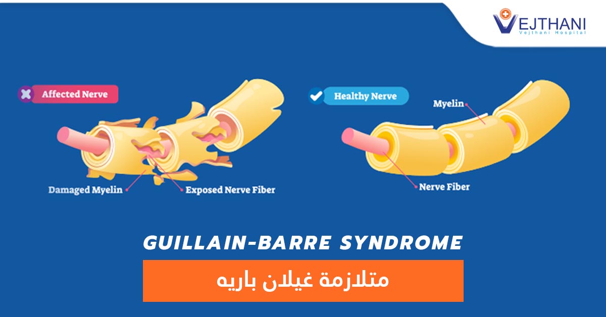 متلازمة غيلان باريه: الأعراض، الأسباب، وخيارات العلاج