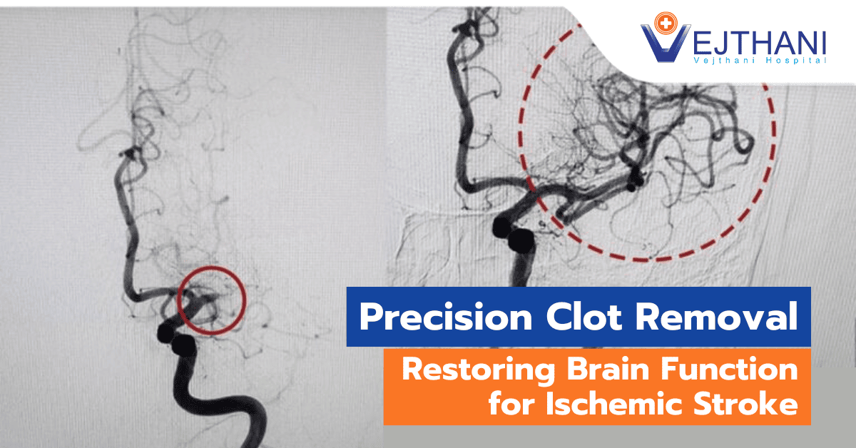 Precision Clot Removal to Restore Brain Function in Ischemic Stroke