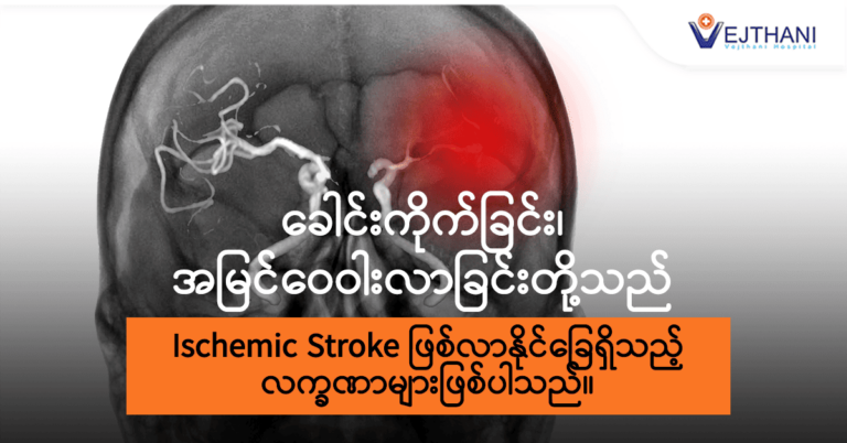 Ischemic stroke သည်-လျစ်လျူမရှုသင့်သေ