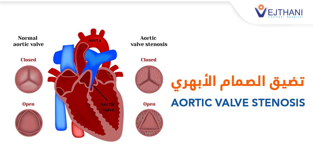 تضيق الصمام الأبهري: الأعراض التي تستدعي الانتباه وأفضل طرق العلاج