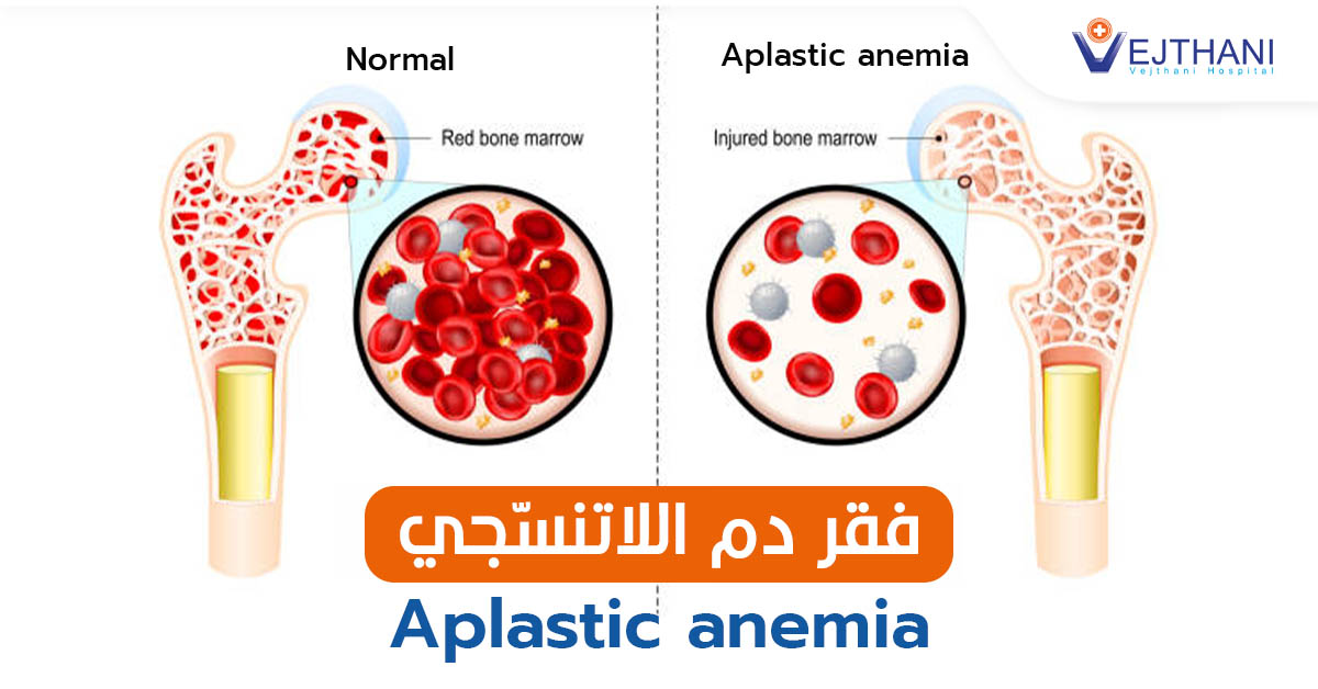 فقر الدم اللاتنسجي: دليل شامل للأسباب والأعراض وأحدث خيارات العلاج