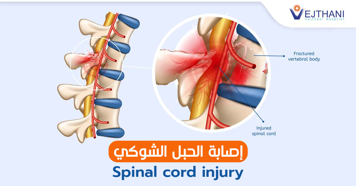 إصابة الحبل الشوكي: نظرة شاملة على الأسباب والأعراض والعلاج