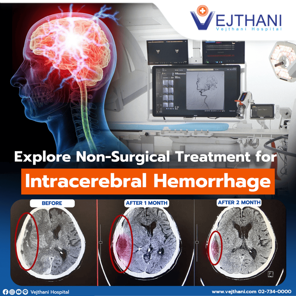 Non-Surgical Treatment for Intracerebral Hemorrhage