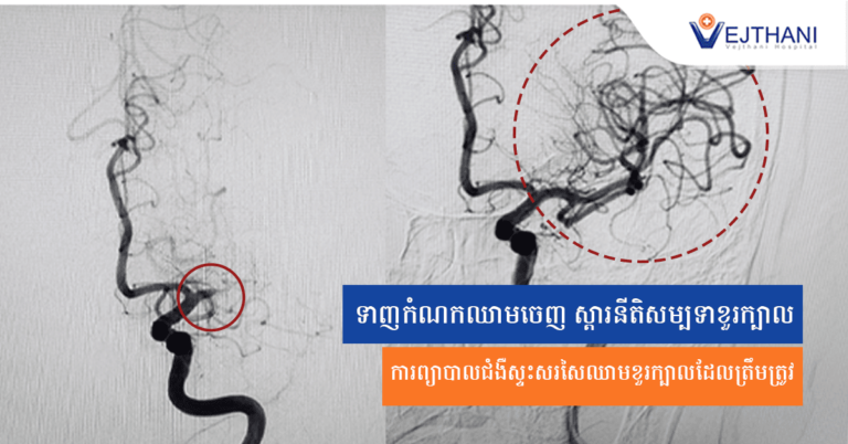 កំណកឈាមចេញ-ជំងឺស្ទះសរសៃឈាមខួរក្បាល