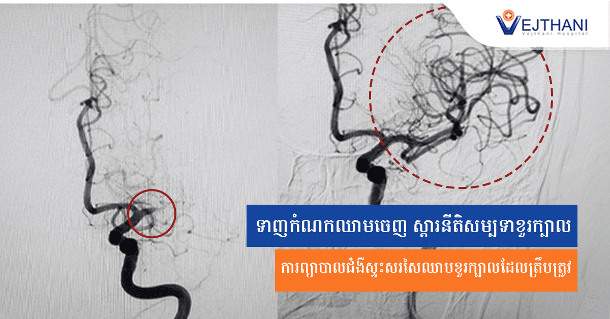 ទាញកំណកឈាមចេញ ស្ដារនីតិសម្បទាខួរក្បាល ការព្យាបាលជំងឺស្ទះសរសៃឈាមខួរក្បាលដែលត្រឹមត្រូវ