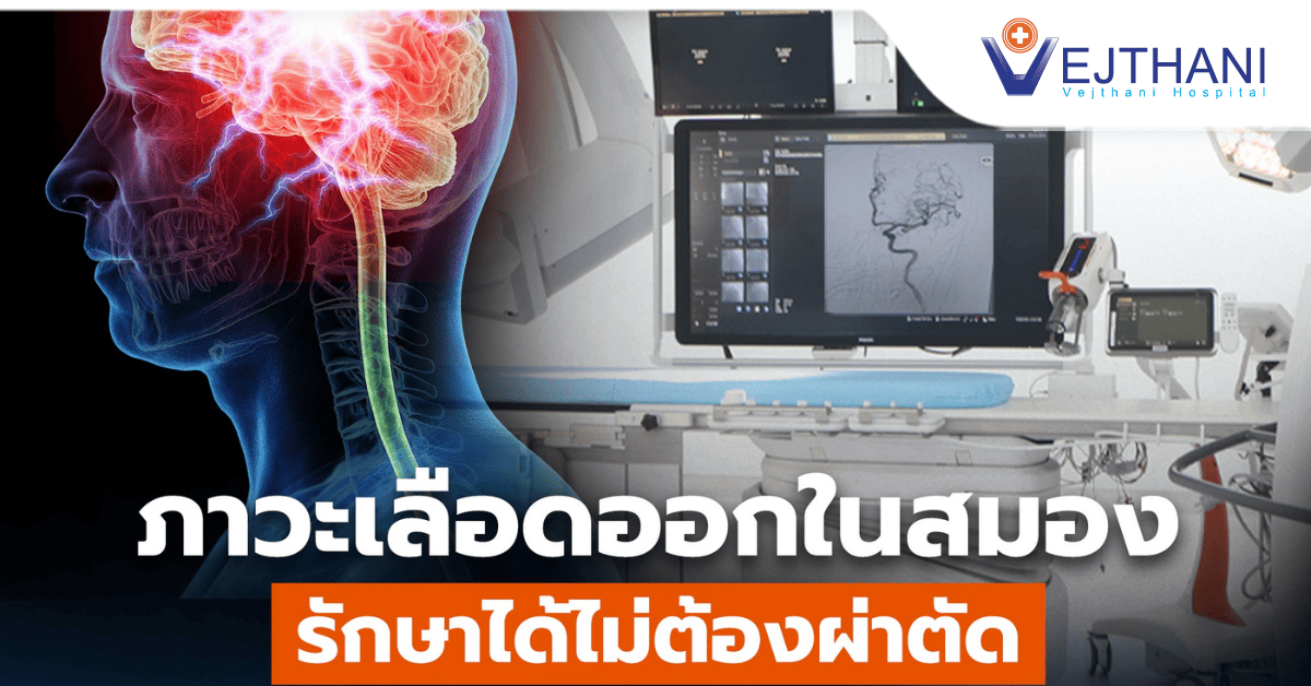 ภาวะเลือดออกในสมอง รักษาได้ไม่ต้องผ่าตัด