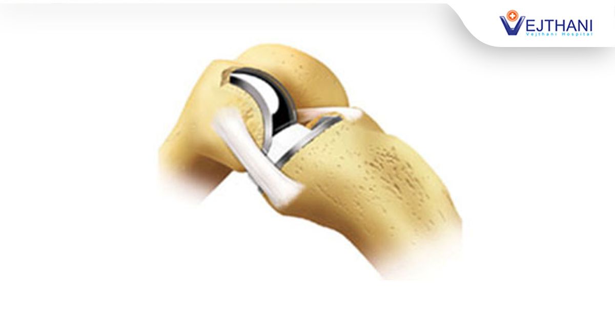 Unicompartmental Knee Arthroplasty (ဒူးဆစ်အစားထိုးခြင်းနည်းပညာသစ်)