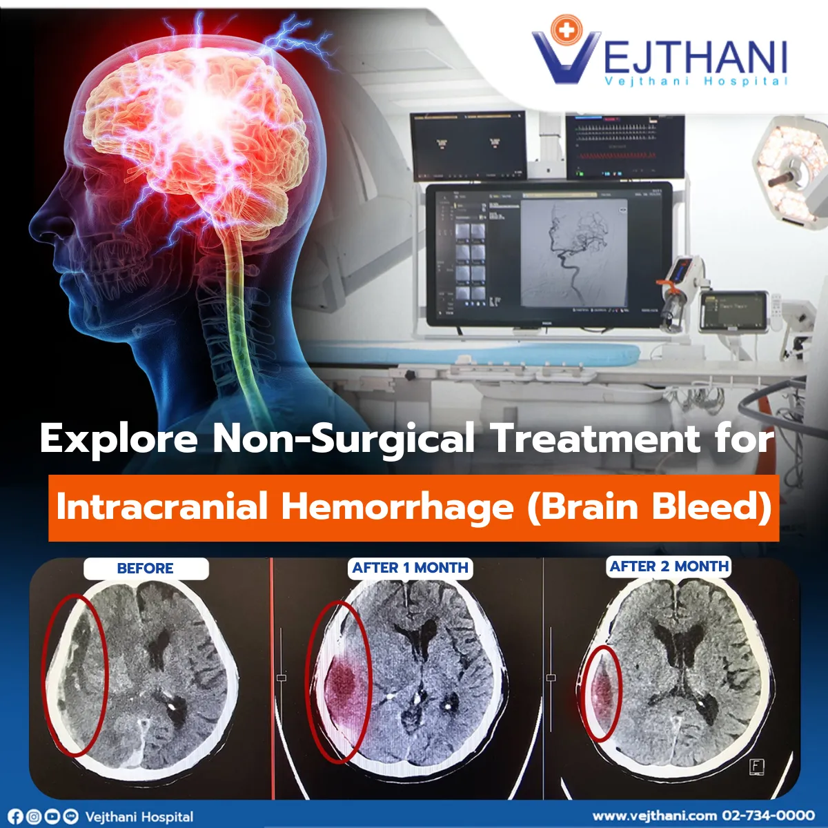 Non-Surgical Treatment for Intracranial Hemorrhage-Brain Bleed