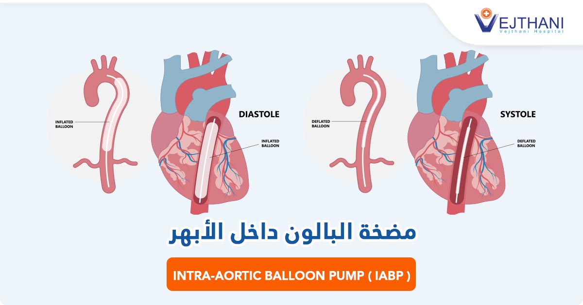 مضخة البالون داخل الأبهر (IABP)