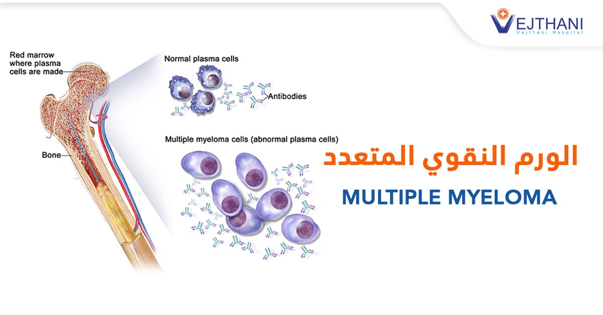 الورم النقوي المتعدد (المايلوما المتعددة)