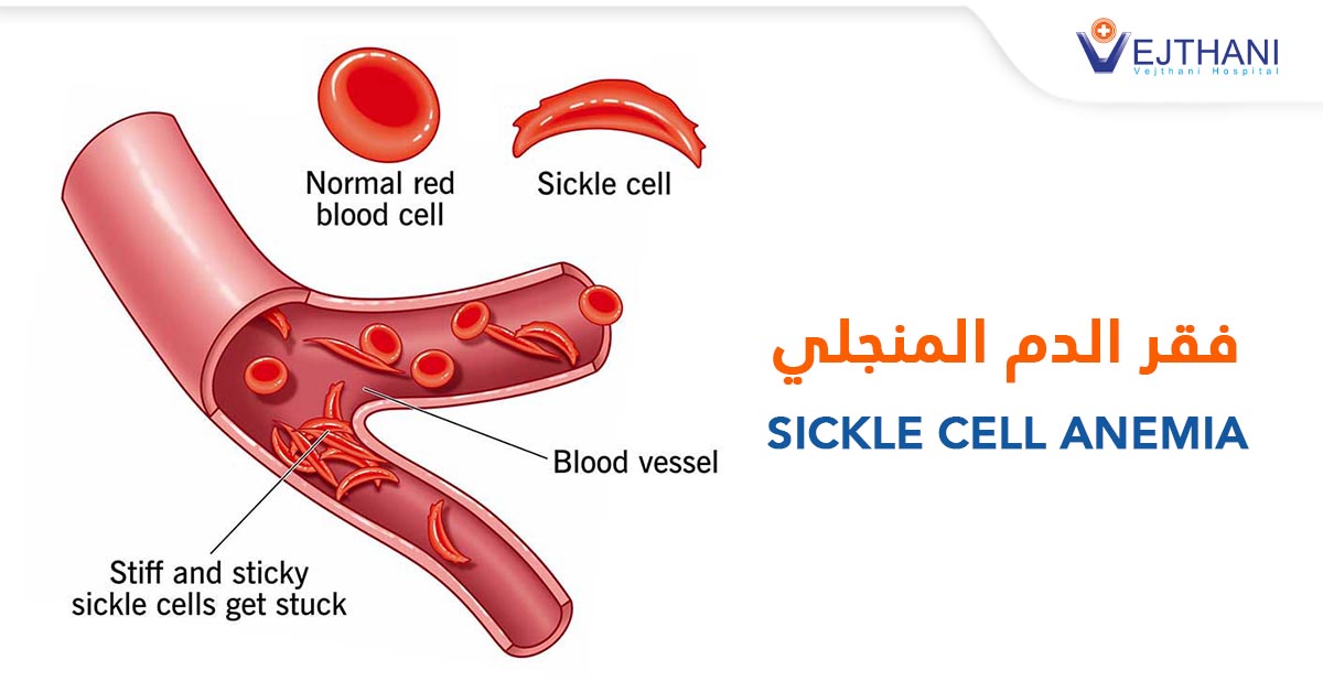 لمحة عامة عن فقر الدم المنجلي