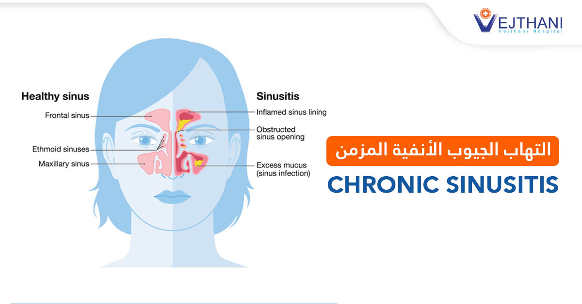 التهاب الجيوب الأنفية المزمن