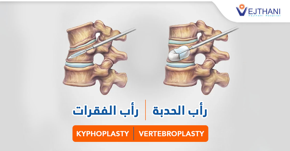 رأب الحدبة / رأب الفقرات