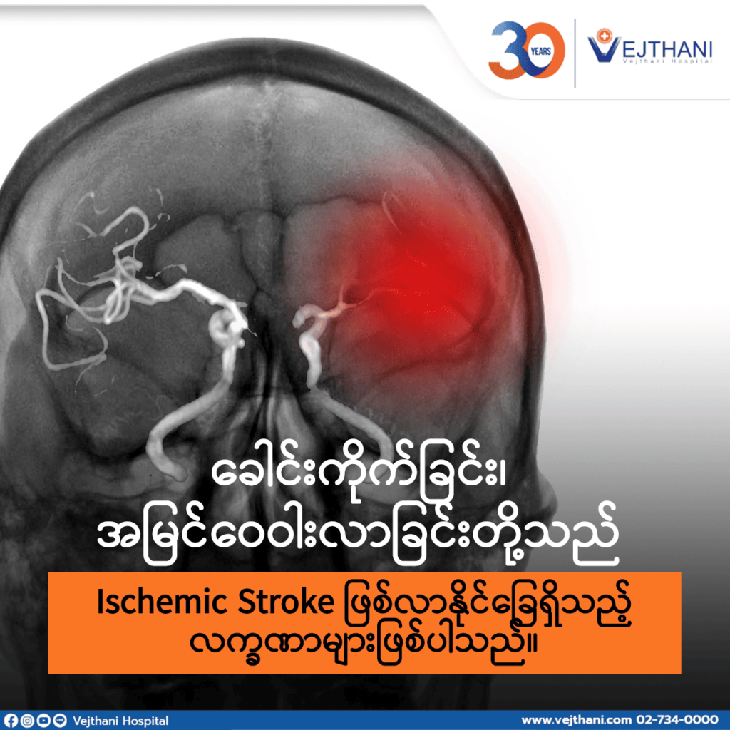 Ischemic stroke သည်-လျစ်လျူမရှုသင့်သေ