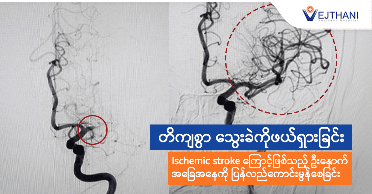 တိကျစွာ သွေးခဲကိုဖယ်ရှားခြင်းဖြင့် Ischemic stroke ကြောင့်ဖြစ်နိုင်သည့် ဦးနှောက်အခြေအနေကို ပြန်လည်ကောင်းမွန်စေခြင်း