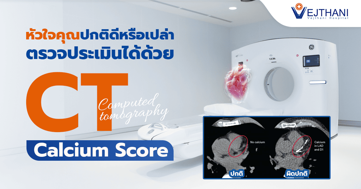 CT Calcium Score การตรวจหาแคลเซียมหลอดเลือดหัวใจเพื่อประเมินความเสี่ยงโรคหัวใจ