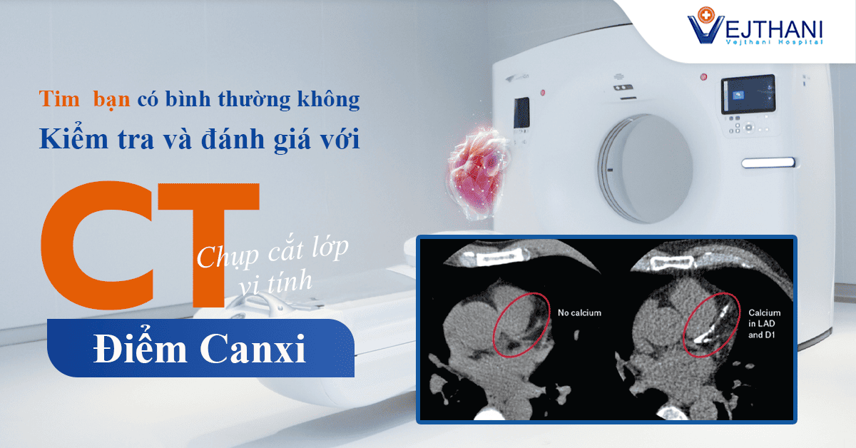 CT Calcium Score – Xét nghiệm canxi tích tụ động mạch vành giúp đánh giá nguy cơ mắc bệnh tim 